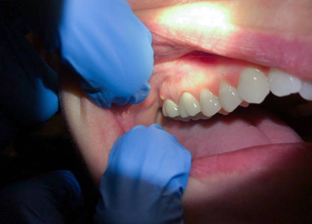 Best Emergency Tooth Extraction in Basking Ridge, NJ